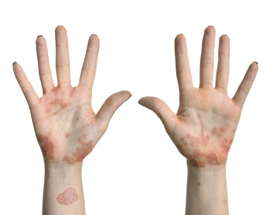 Die ersten Symptome einer Psoriasis